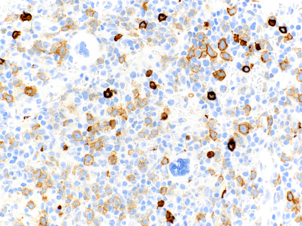 CD117 staining of subset of blasts (40x).